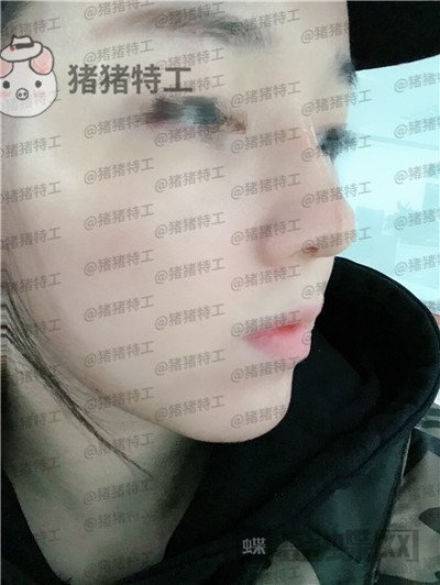 成都西区医院,车红昌,,案例,价格,