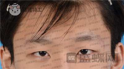 北京美莱,余辉,,案例,价格,