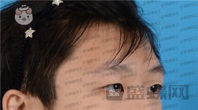 北京美莱,余辉,,案例,价格,