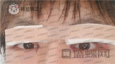 北京美莱,余辉,,案例,价格,