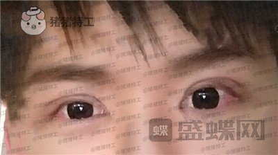 北京美莱,余辉,,案例,价格,