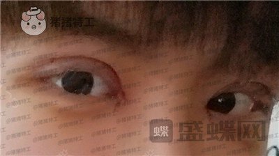北京美莱,余辉,,案例,价格,