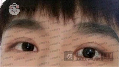 北京美莱,余辉,,案例,价格,
