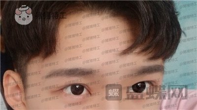 北京美莱,余辉,,案例,价格,