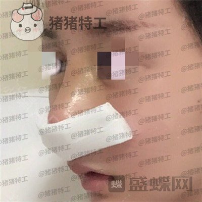 北京八大处王欢鼻修复案例价格分享，这么失败的鼻子以为没救了多谢医生妙手回春~