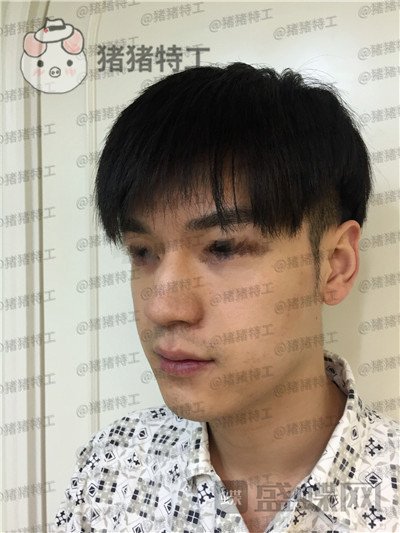 北京美莱,黄罡,隆鼻,驼峰鼻修正,案例,价格,