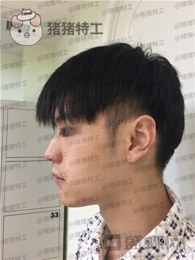 北京美莱,黄罡,隆鼻,驼峰鼻修正,案例,价格,