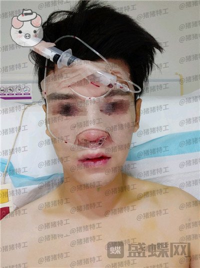 北京美莱,黄罡,隆鼻,驼峰鼻修正,案例,价格,