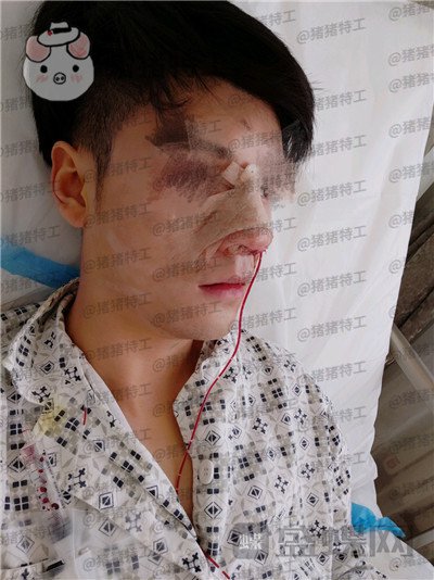 北京美莱,黄罡,隆鼻,驼峰鼻修正,案例,价格,