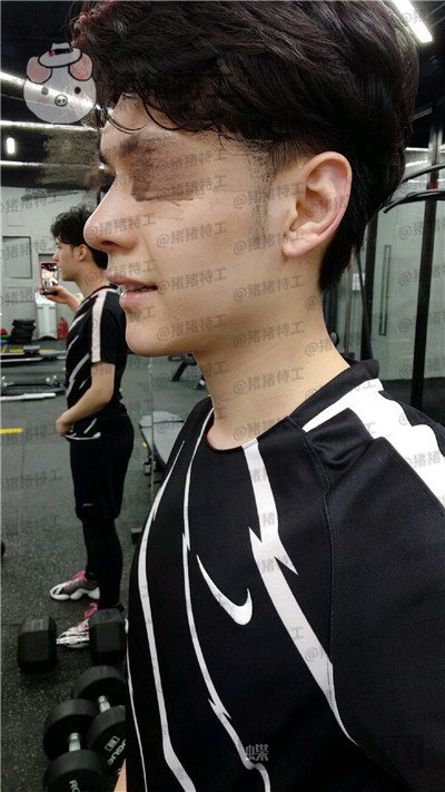 北京美莱,黄罡,隆鼻,驼峰鼻修正,案例,价格,