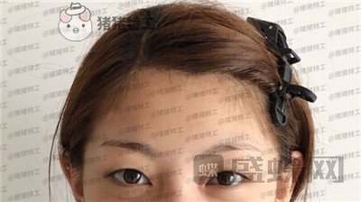 杭州美莱,张霞飞,双眼皮,案例,价格,
