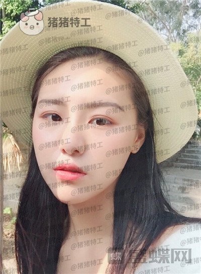 兰州亚韩,李军梅,隆鼻,案例,价格,