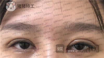 北京百达丽,上海九院,苏婷,双眼皮,修复,案例,价格,