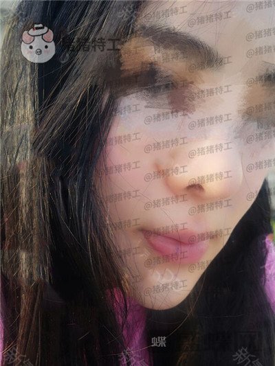 北京壹加壹,张绿峰,面部填充,案例,价格,