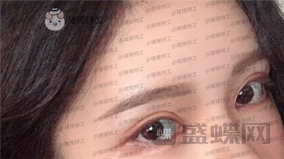 杭州伊琳,毛琪,双眼皮,修复,案例,价格,