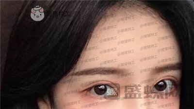 杭州伊琳,毛琪,双眼皮,修复,案例,价格,