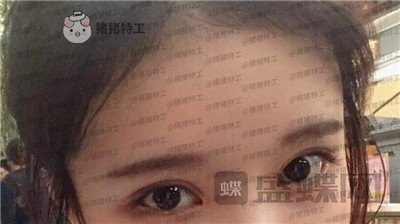 杭州伊琳,毛琪,双眼皮,修复,案例,价格,