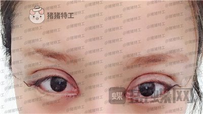 沈阳和平美联致美,管连斌,双眼皮,案例,价格,