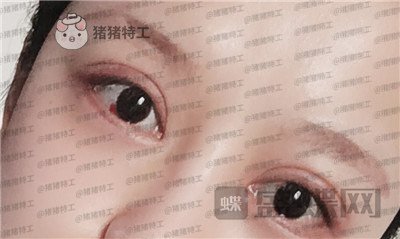 沈阳和平美联致美,管连斌,双眼皮,案例,价格,