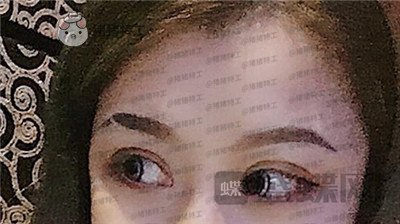 沈阳和平美联致美,管连斌,双眼皮,案例,价格,