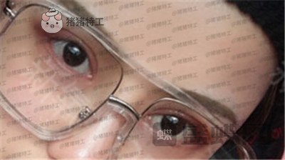 沈阳和平美联致美,管连斌,双眼皮,案例,价格,