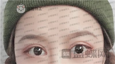 沈阳和平美联致美,管连斌,双眼皮,案例,价格,