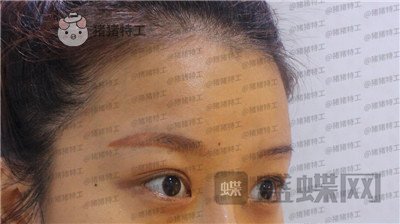 沈阳和平美联致美,管连斌,双眼皮,案例,价格,