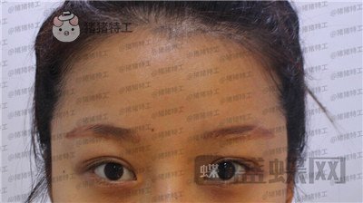沈阳和平美联致美,管连斌,双眼皮,案例,价格,