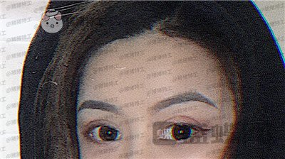 沈阳和平美联致美,管连斌,双眼皮,案例,价格,