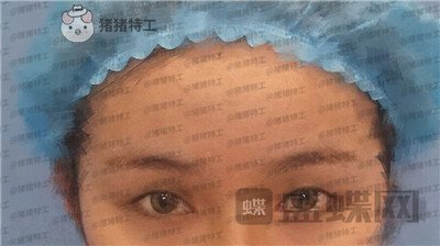 南京美贝尔,黄名斗,双眼皮,案例,价格,