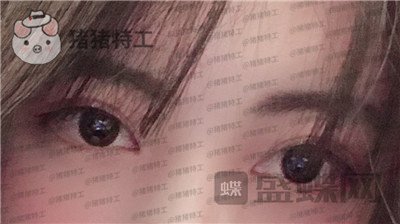北京长虹,张守玲,双眼皮,案例,价格,