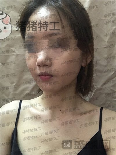 成都美容整形李静面部填充案例价格分享，感觉没果医生说两三个月才能看出来。