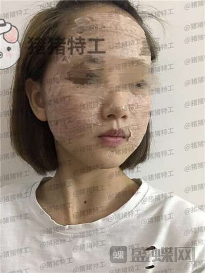 成都美容整形李静面部填充案例价格分享，感觉没果医生说两三个月才能看出来。