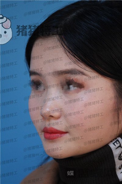 武汉同济,曾宁,隆鼻,案例,价格,