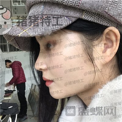武汉同济,曾宁,隆鼻,案例,价格,