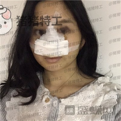 武汉同济,曾宁,隆鼻,案例,价格,