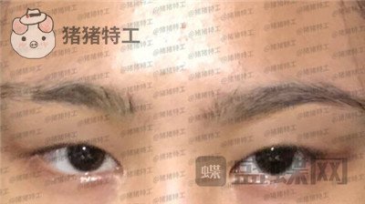 杭州美莱,韩超,双眼皮,案例,价格,