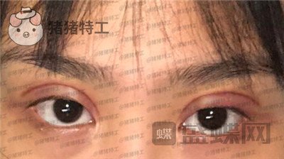 杭州美莱,韩超,双眼皮,案例,价格,