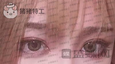 杭州美莱,韩超,双眼皮,案例,价格,