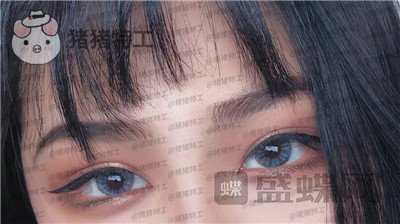 杭州美莱,韩超,双眼皮,案例,价格,