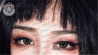 杭州美莱,韩超,双眼皮,案例,价格,