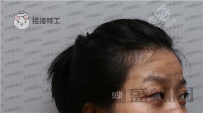 武汉美基元,,双眼皮,案例,价格,