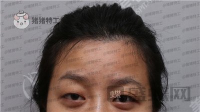 武汉美基元,,双眼皮,案例,价格,