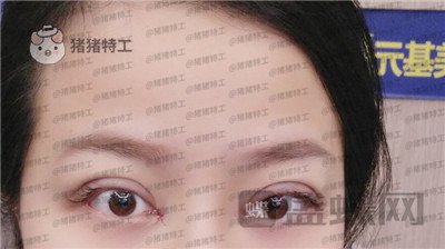 武汉美基元,,双眼皮,案例,价格,
