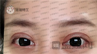 武汉美基元,,双眼皮,案例,价格,