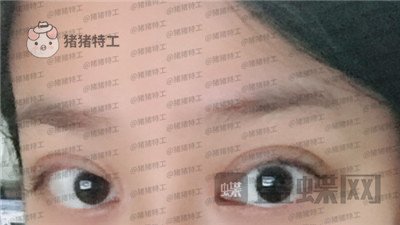武汉美基元,,双眼皮,案例,价格,