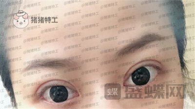 武汉美基元,,双眼皮,案例,价格,