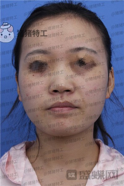 苏州美莱,吴蓉,,案例,价格,