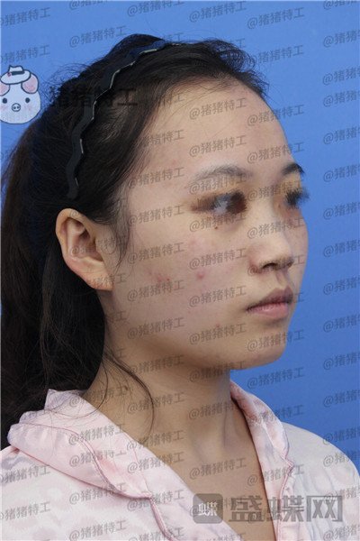 苏州美莱,吴蓉,,案例,价格,