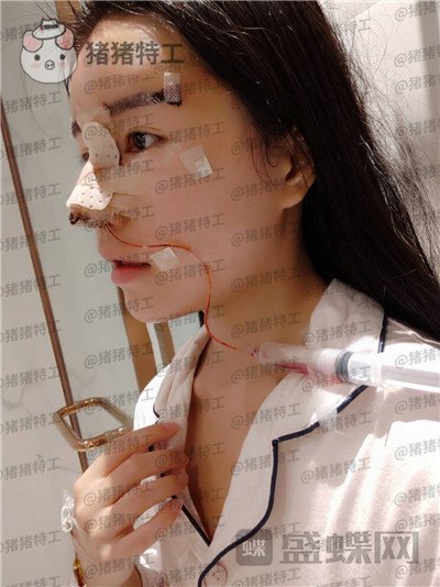 成都格莱丽,王伟,隆鼻,案例,价格,